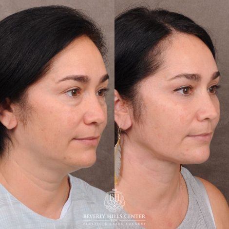 Beverly Hills Center Female Patient Before and After Weekend Necklift, Profound RF, Lower Eyelid Fat Repositioning
