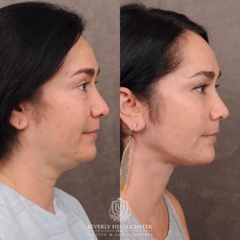 Beverly Hills Center Female Patient Before and After Weekend Necklift, Profound RF, Lower Eyelid Fat Repositioning