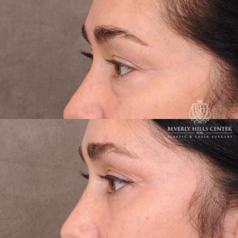 Beverly Hills Center Female Patient Before and After Weekend Necklift, Profound RF, Lower Eyelid Fat Repositioning