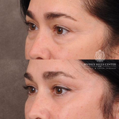 Beverly Hills Center Female Patient Before and After Weekend Necklift, Profound RF, Lower Eyelid Fat Repositioning