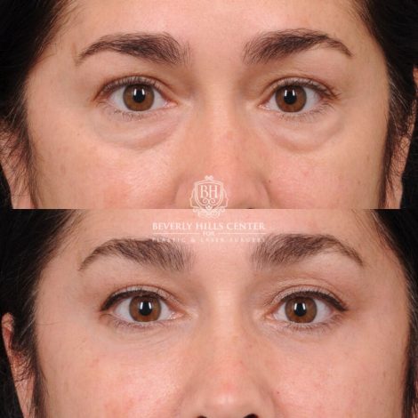 Beverly Hills Center Female Patient Before and After Weekend Necklift, Profound RF, Lower Eyelid Fat Repositioning