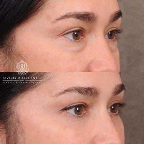 Beverly Hills Center Female Patient Before and After Weekend Necklift, Profound RF, Lower Eyelid Fat Repositioning