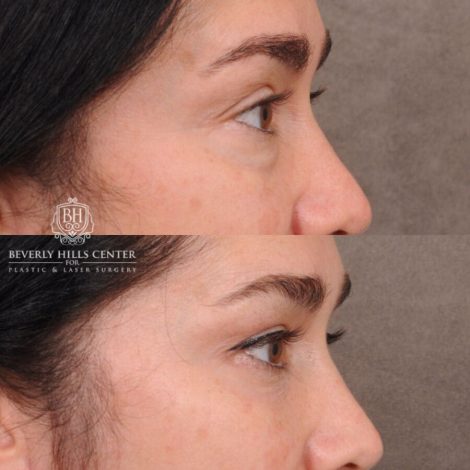 Beverly Hills Center Female Patient Before and After Weekend Necklift, Profound RF, Lower Eyelid Fat Repositioning