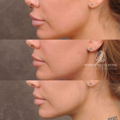Beverly Hills Center Female Patient Before and After CUPID LIFT® Corner Lift