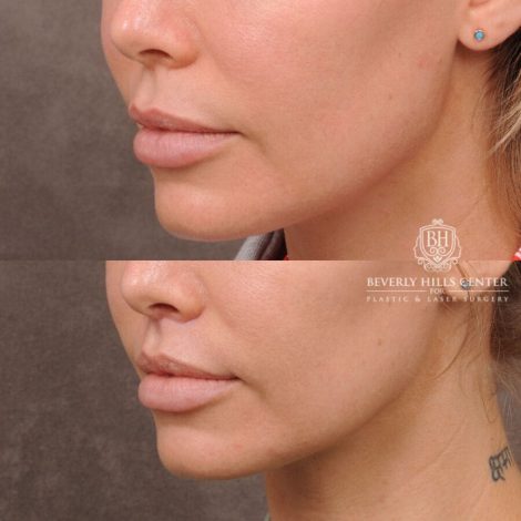 Beverly Hills Center Female Patient Before and After CUPID LIFT® Corner Lift