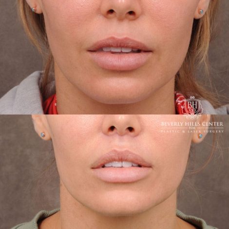 Beverly Hills Center Female Patient Before and After CUPID LIFT® Corner Lift