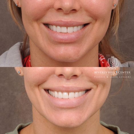 Beverly Hills Center Female Patient Before and After CUPID LIFT® Corner Lift