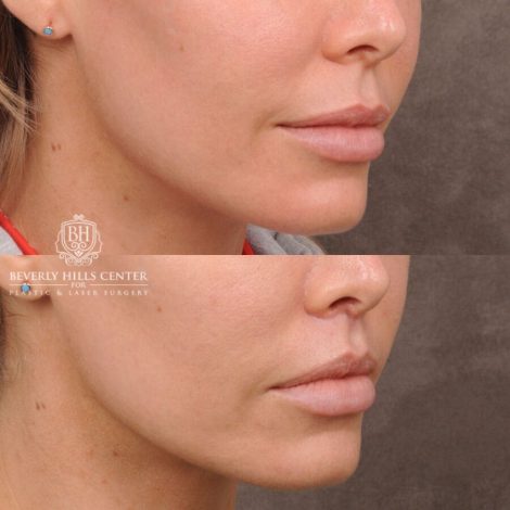 Beverly Hills Center Female Patient Before and After CUPID LIFT® Corner Lift