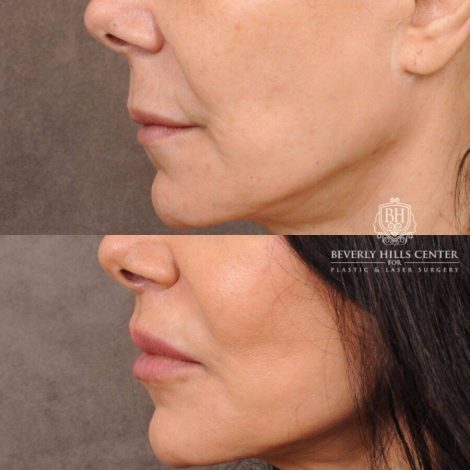 Beverly Hills Center Female Patient Before and After CUPID LIFT®