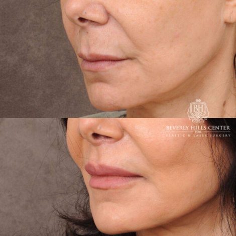 Beverly Hills Center Female Patient Before and After CUPID LIFT®