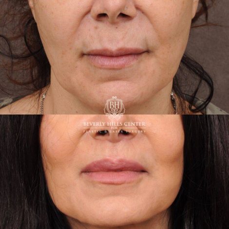 Beverly Hills Center Female Patient Before and After CUPID LIFT®