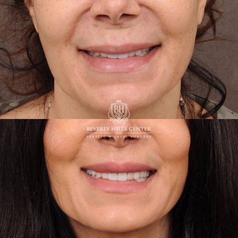 Beverly Hills Center Female Patient Before and After CUPID LIFT®
