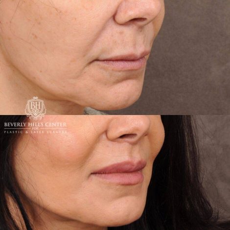 Beverly Hills Center Female Patient Before and After CUPID LIFT®