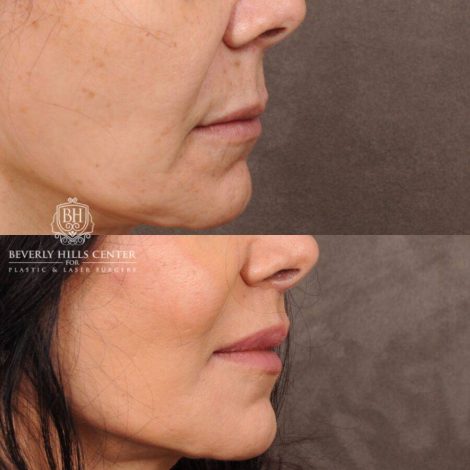 Beverly Hills Center Female Patient Before and After CUPID LIFT®