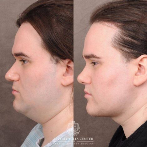 Beverly Hills Center Male Patient Before and After Weekend Necklift, Primary Rhinoplasty, Lip Lift