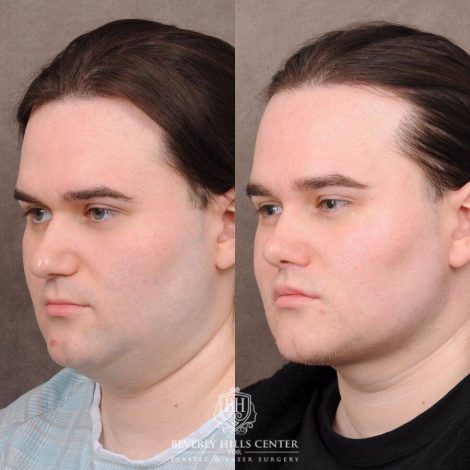 Beverly Hills Center Male Patient Before and After Weekend Necklift, Primary Rhinoplasty, Lip Lift