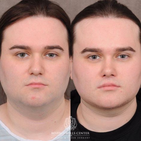 Beverly Hills Center Male Patient Before and After Weekend Necklift, Primary Rhinoplasty, Lip Lift