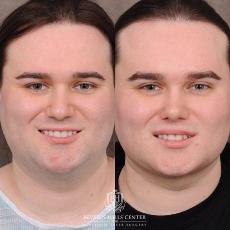 Beverly Hills Center Male Patient Before and After Weekend Necklift, Primary Rhinoplasty, Lip Lift