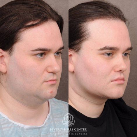 Beverly Hills Center Male Patient Before and After Weekend Necklift, Primary Rhinoplasty, Lip Lift