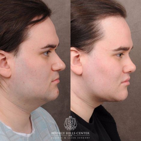 Beverly Hills Center Male Patient Before and After Weekend Necklift, Primary Rhinoplasty, Lip Lift