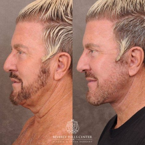 Beverly Hills Center Male Patient Before and After AuraLyft