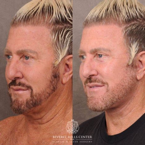 Beverly Hills Center Male Patient Before and After AuraLyft