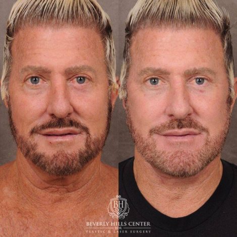 Beverly Hills Center Male Patient Before and After AuraLyft