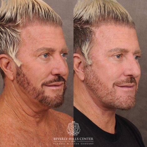 Beverly Hills Center Male Patient Before and After AuraLyft