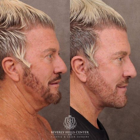 Beverly Hills Center Male Patient Before and After AuraLyft