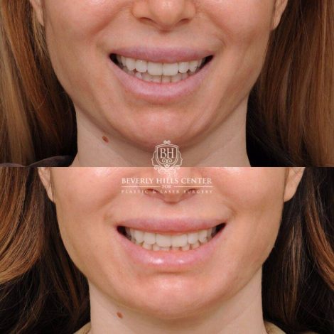 Beverly Hills Center Female Patient Before and After CUPID LIFT® Lip Lift