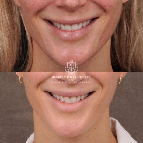Beverly Hills Center Female Patient Before and After CUPID LIFT® Lip Lift