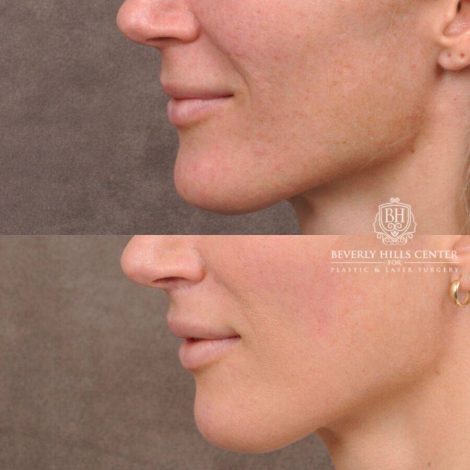 Beverly Hills Center Female Patient Before and After CUPID LIFT® Lip Lift & Profound