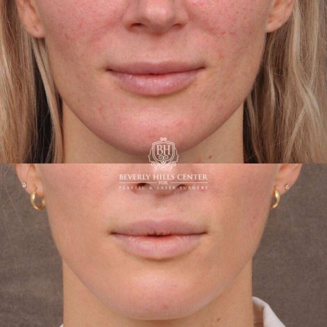 Beverly Hills Center Female Patient Before and After CUPID LIFT® Lip Lift & Profound