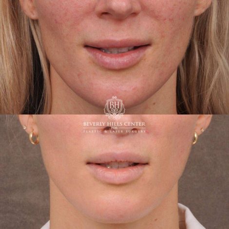 Beverly Hills Center Female Patient Before and After CUPID LIFT® Lip Lift & Profound
