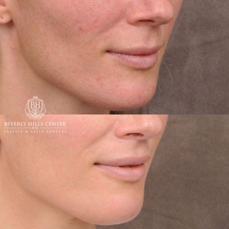 Beverly Hills Center Female Patient Before and After CUPID LIFT® Lip Lift & Profound