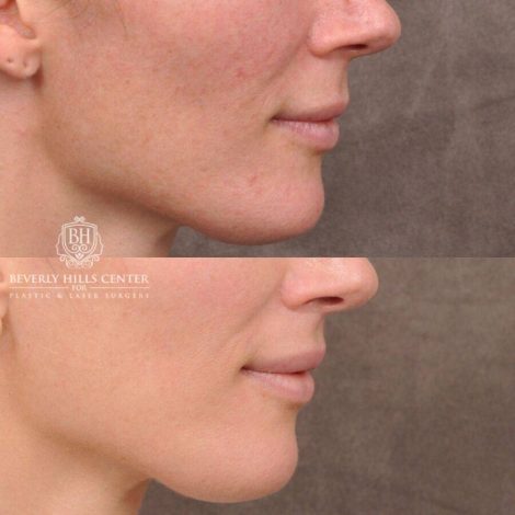 Beverly Hills Center Female Patient Before and After CUPID LIFT® Lip Lift & Profound