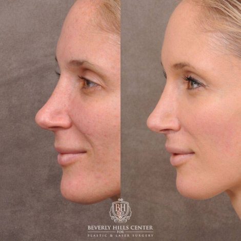 Beverly Hills Center Female Patient Before and After CUPID LIFT® Lip Lift & Profound