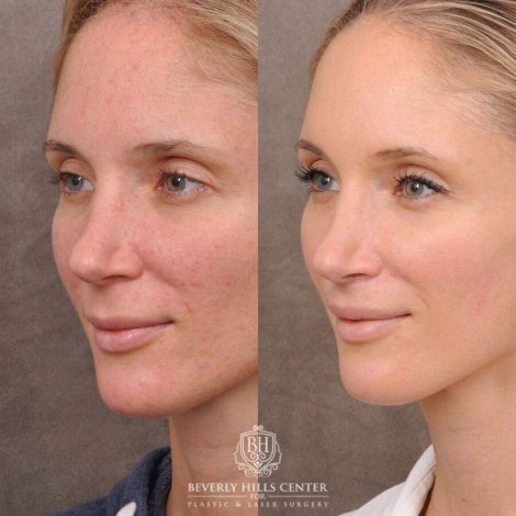Beverly Hills Center Female Patient Before and After CUPID LIFT® Lip Lift & Profound