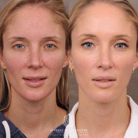Beverly Hills Center Female Patient Before and After CUPID LIFT® Lip Lift & Profound