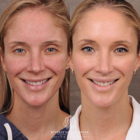 Beverly Hills Center Female Patient Before and After CUPID LIFT® Lip Lift & Profound