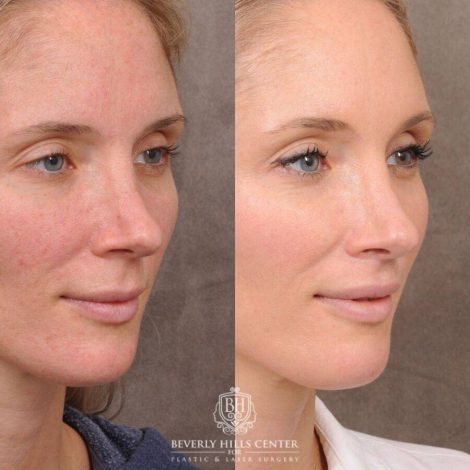 Beverly Hills Center Female Patient Before and After CUPID LIFT® Lip Lift & Profound