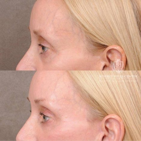 Beverly Hills Center Female Patient Before and After Upper Eyelid Blepharoplasty with Fat Repositioning