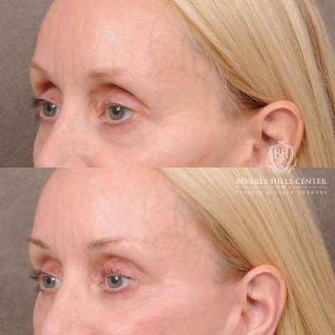 Beverly Hills Center Female Patient Before and After Upper Eyelid Blepharoplasty with Fat Repositioning