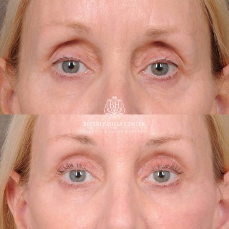 Beverly Hills Center Female Patient Before and After Upper Eyelid Blepharoplasty with Fat Repositioning