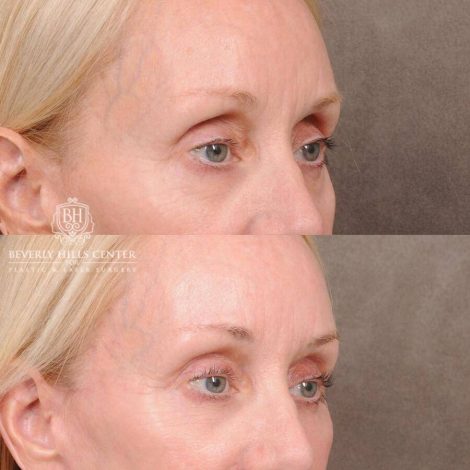 Beverly Hills Center Female Patient Before and After Upper Eyelid Blepharoplasty with Fat Repositioning