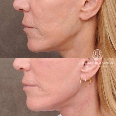 Beverly Hills Center Female Patient Before and After CUPID LIFT® Corner Lift with Perioral CO2 Laser Resurfacing