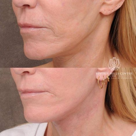 Beverly Hills Center Female Patient Before and After CUPID LIFT® Corner Lift with Perioral CO2 Laser Resurfacing