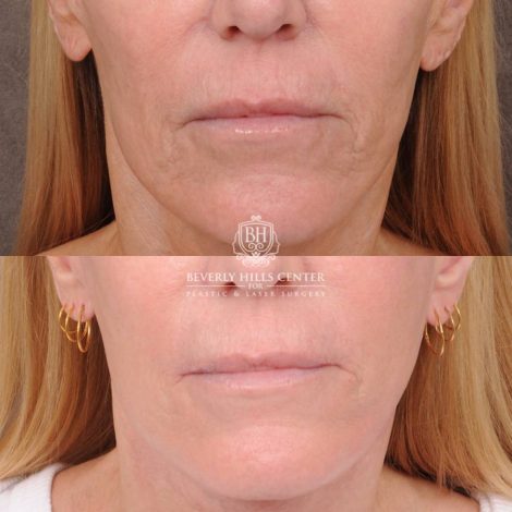 Beverly Hills Center Female Patient Before and After CUPID LIFT® Corner Lift with Perioral CO2 Laser Resurfacing