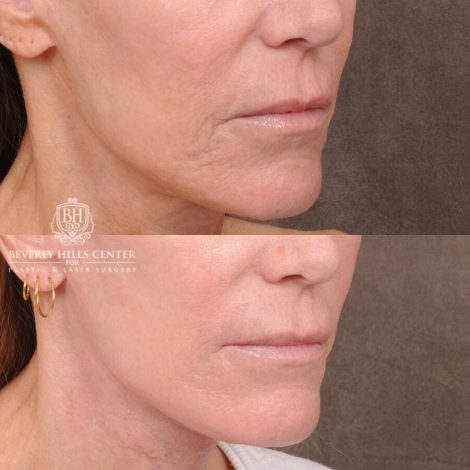 Beverly Hills Center Female Patient Before and After CUPID LIFT® Corner Lift with Perioral CO2 Laser Resurfacing