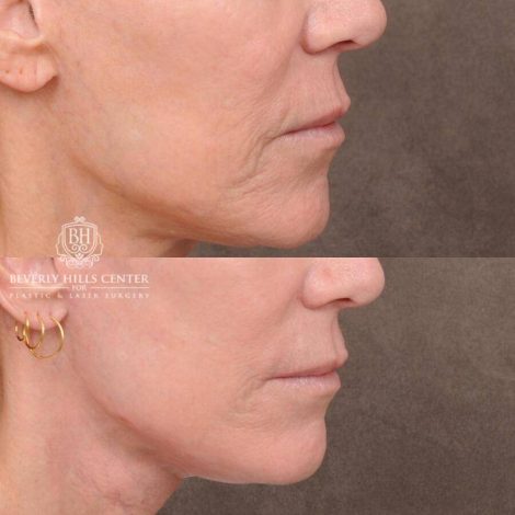 Beverly Hills Center Female Patient Before and After CUPID LIFT® Corner Lift with Perioral CO2 Laser Resurfacing